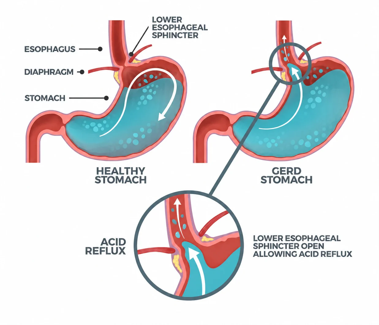 Diagram comparing a healthy anti-reflux valve with gastro-oesophageal reflux
