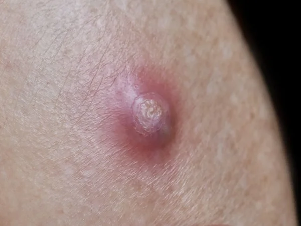 Red, swollen boil with a yellow head on the skin