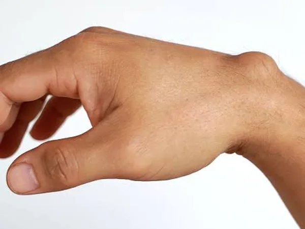 Ganglion swelling on the back of the wrist