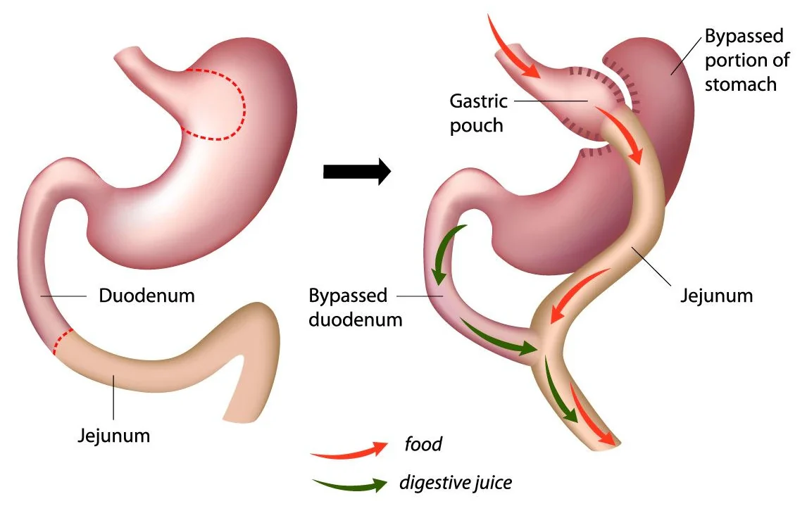Diagram showing a small gastric pouch and rerouted bowel after Roux-en-Y gastric bypass