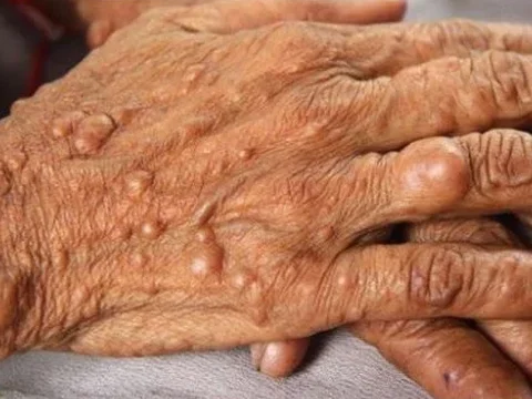 Several small neurofibromas on the back of the hand