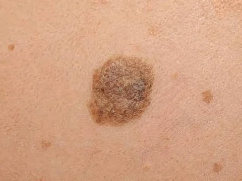 Raised brown seborrhoeic keratosis on the skin