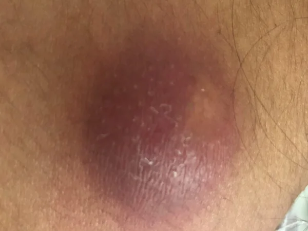 Red, swollen skin abscess with pus near the surface