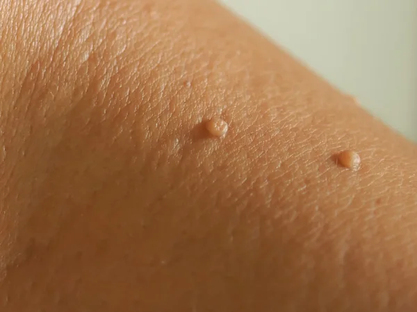 Small skin tags on the neck
