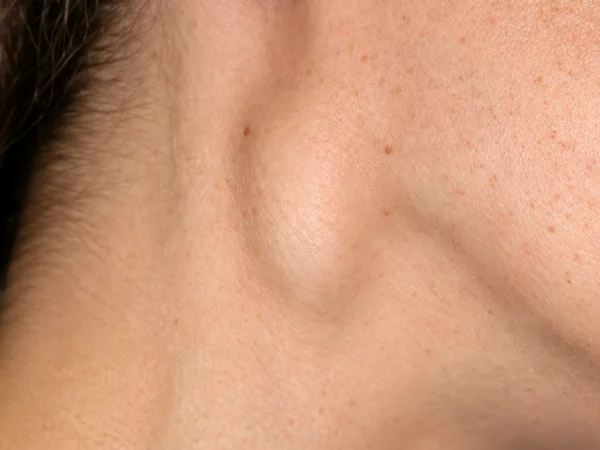 Swollen lymph gland in the side of the neck
