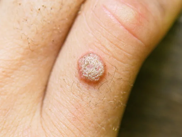Rough wart on a finger